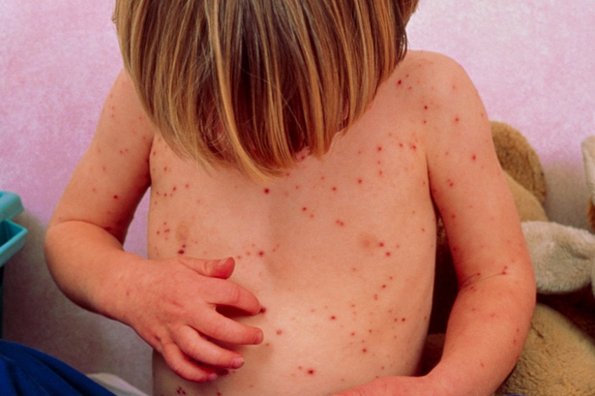 Epidemiolozi apeluju na što hitniju vakcinaciju djece
